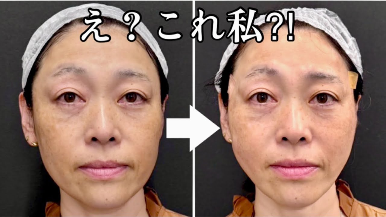 【美容医療】誰？こんなに変わる⁈「悩み」を伝えたら若返りすぎた！！美容医療の進化に驚愕😳