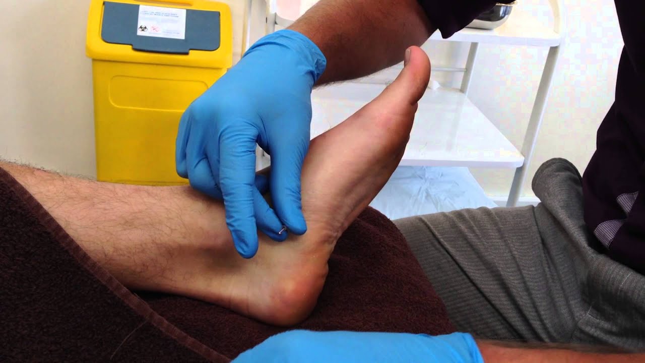 Dry Needling: Abductor Hallucis