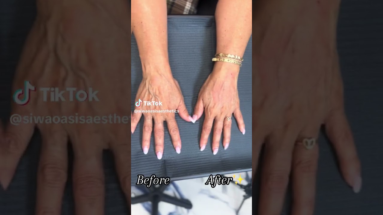 Hand Filler at @SiwaOasisAesthetics