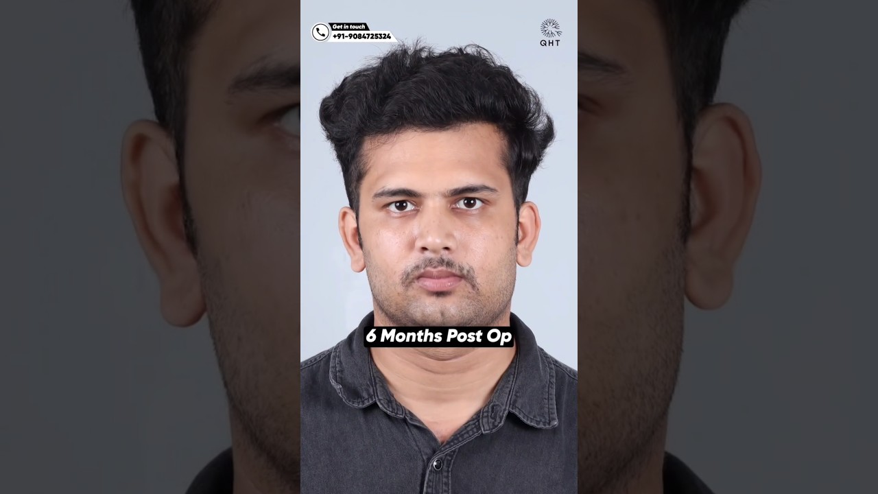 Just 6 Months after Hair transplant #qht #hairtransplant #ytshortsindia #shorts #hairloss #trending
