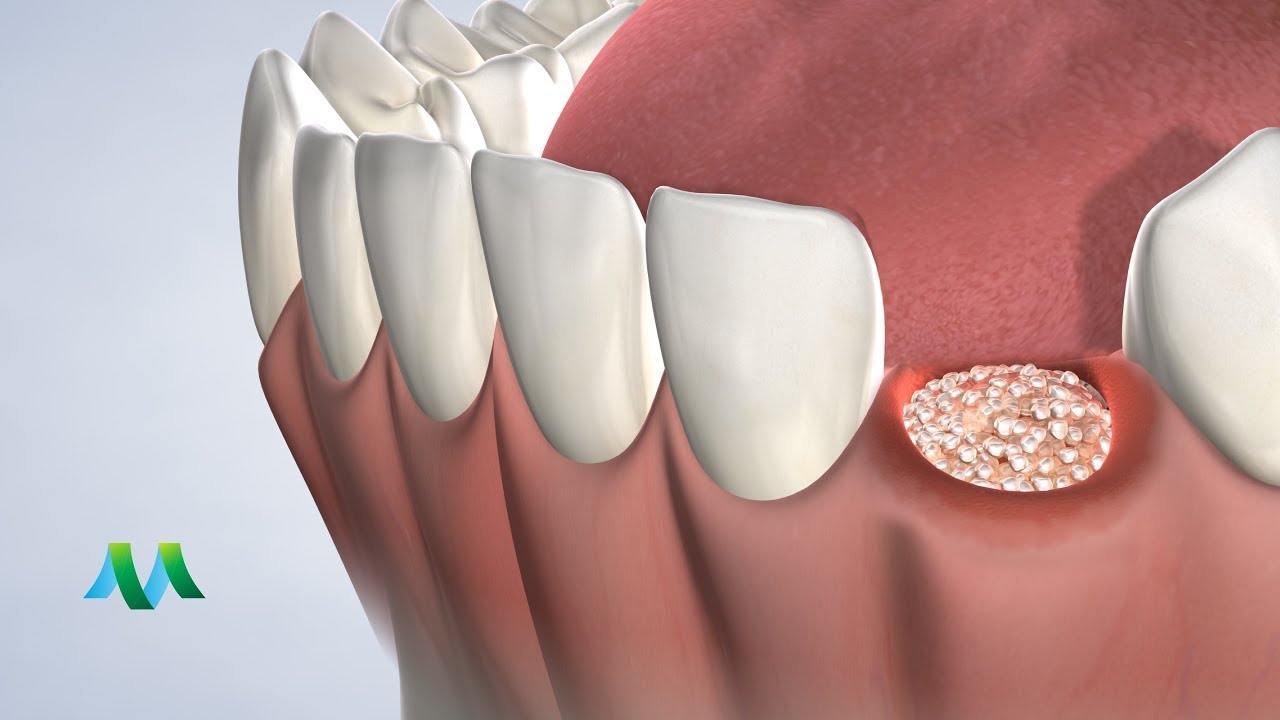 Socket Preservation in Flint MI | Greater Michigan Oral Surgeons & Dental Implant Center