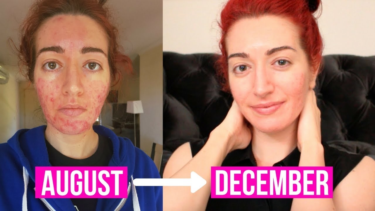 4 MONTH ACCUTANE UPDATE | How To Care For Your Skin On Accutane