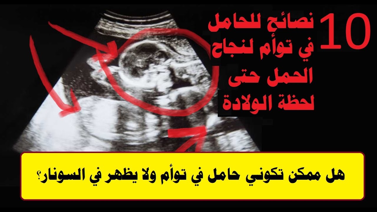 هل ممكن تكوني حامل في توأم ولا يظهر في السونار؟و10 نصائح للحامل في توأم لنجاح الحمل حتى لحظة الولادة