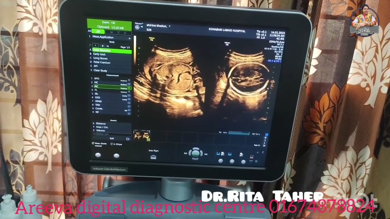 ছয় মাসের আল্ট্রাসনোগ্রাফি লাইভ ভিডিও দেখে নিন