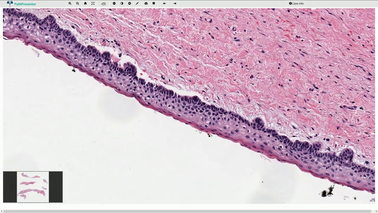 Odontogenic Keratocyst - Histopathology