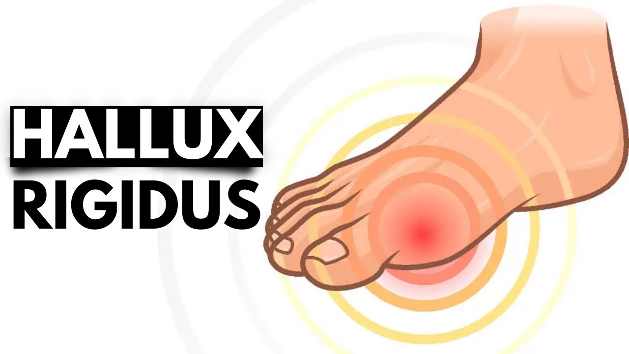 Hallux Rigidus: The Stiff Big Toe Condition and Treatment Options