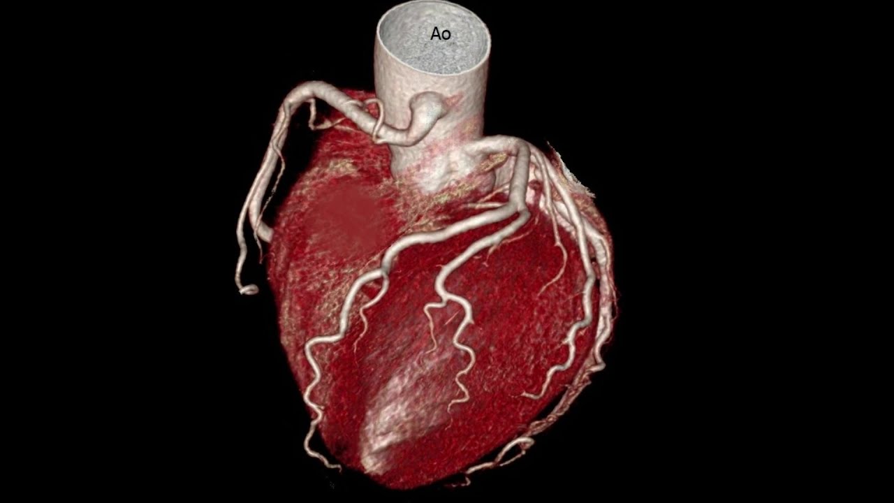 CINRE - Infarkt myokardu STEMI
