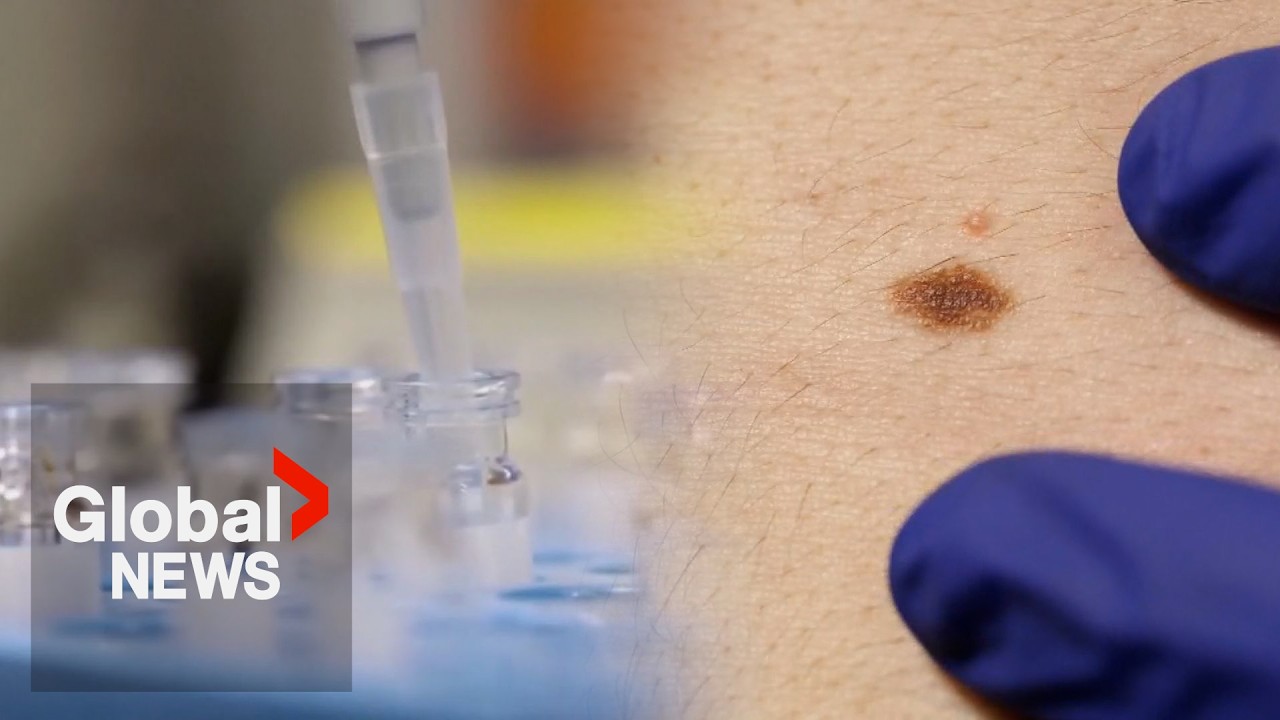 Moderna says new mRNA vaccine stops melanoma from returning