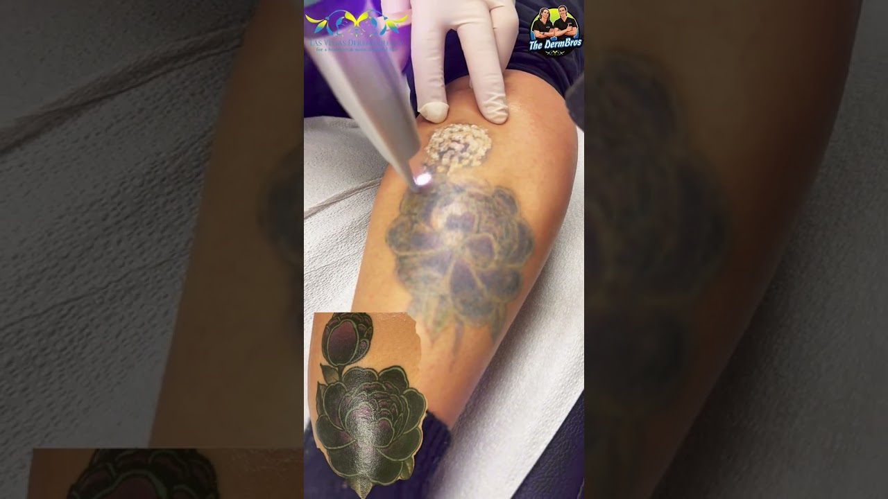 Laser⚡️Tattoo ⚡️Removal 💥 Treatment #10 at Las Vegas Dermatology