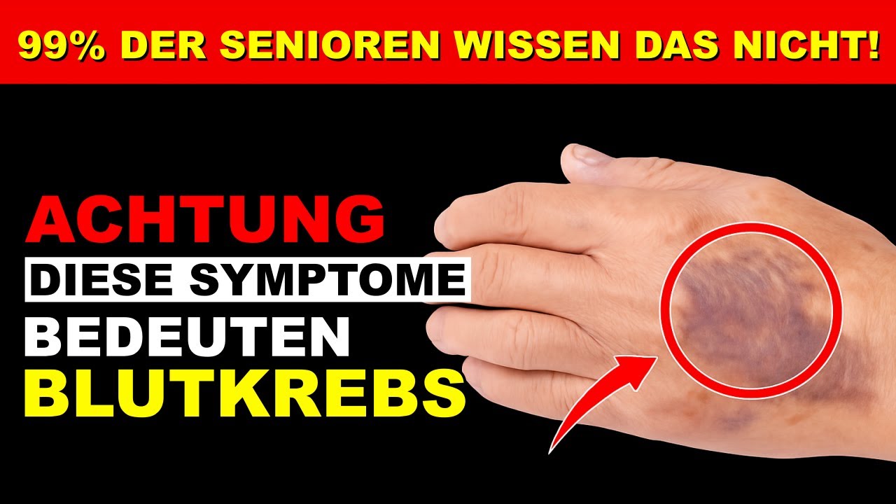 LEUK&Auml;MIE SYMPTOME: 6 WARNZEICHEN f&uuml;r BLUTKREBS