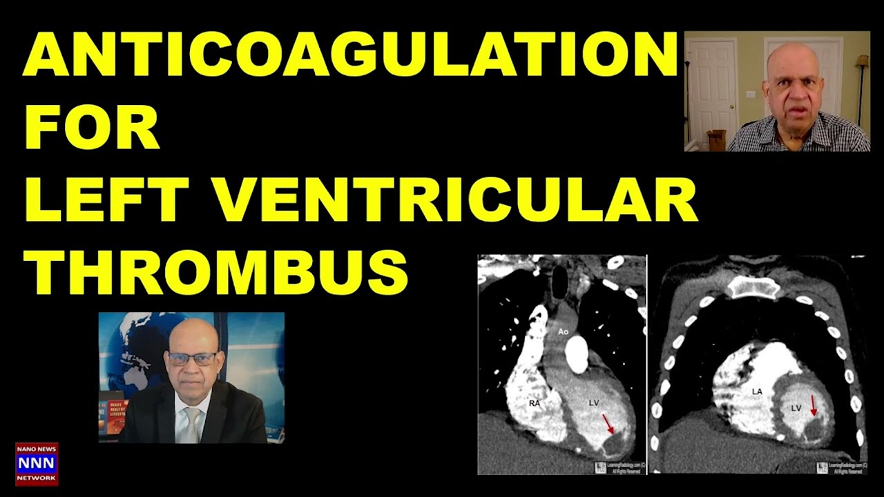 Management of LEFT VENTRICULAR  Thrombus by DR NIK NIKAM 2024