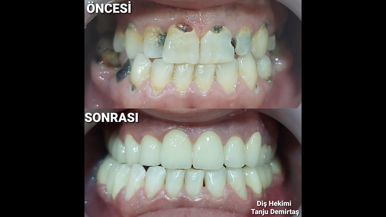 zirkonyum ve e-max kaplama diş nedir?