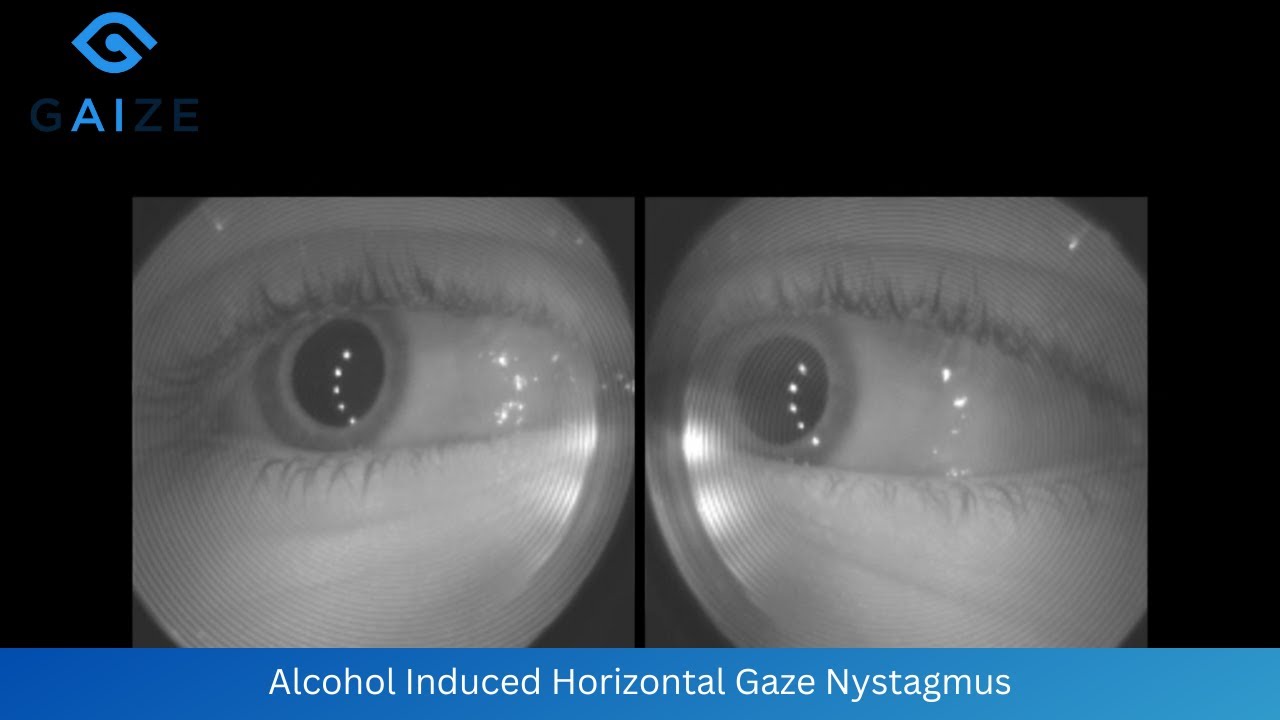 Alcohol Induced Horizontal Gaze Nystagmus at Maximum Deviation
