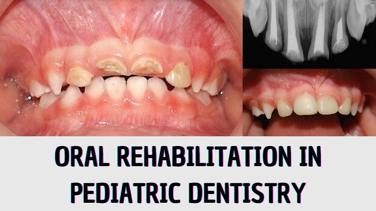 CLINICAL CASE: Oral rehabilitation in pediatric dentistry