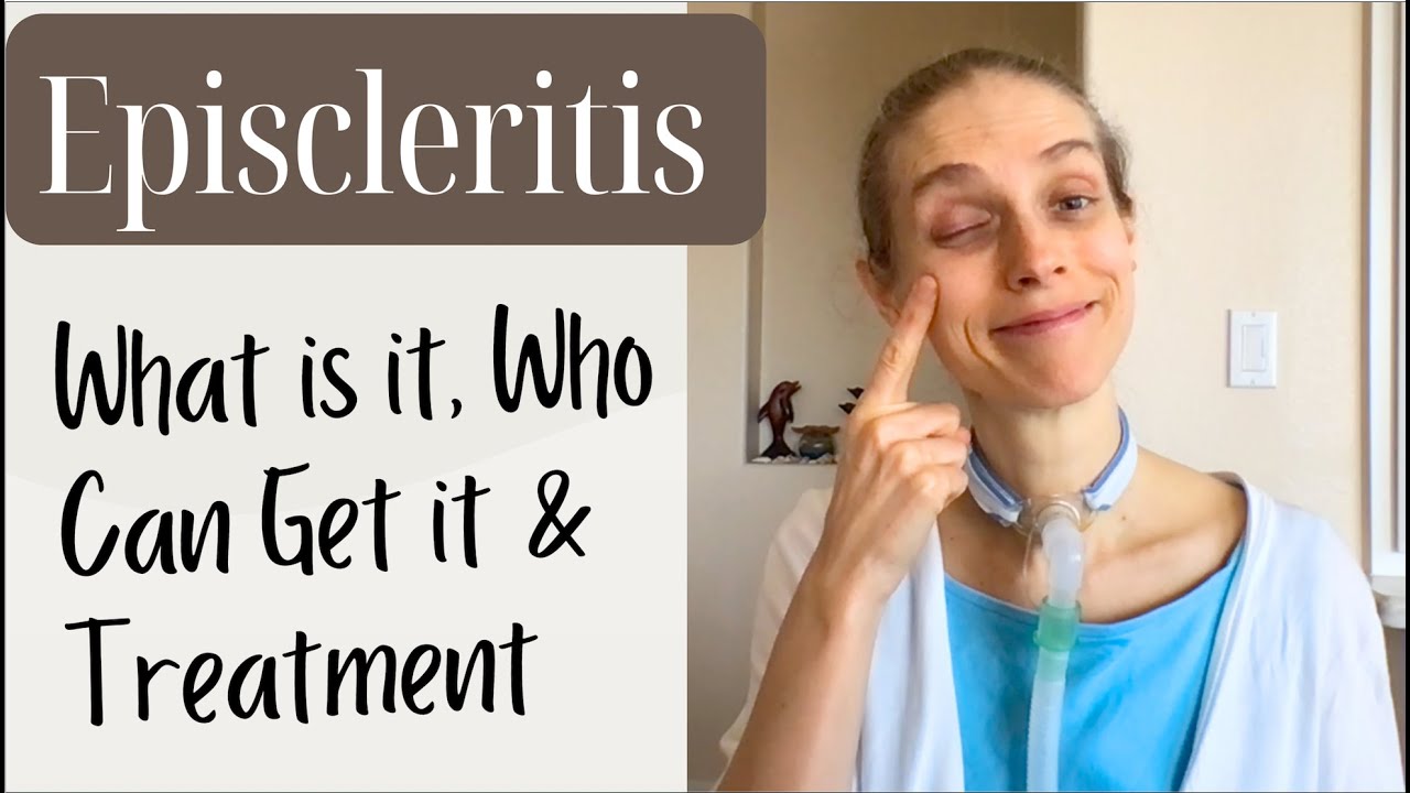 Oh My Eye! Episcleritis. What is It, Who It Affects & Treatment. Life with a Vent