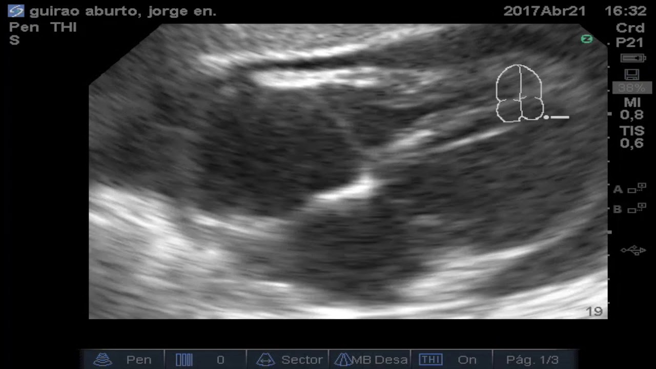 ECO 8.1.3: Pericarditis subcostal eje largo Xalapa Veracruz