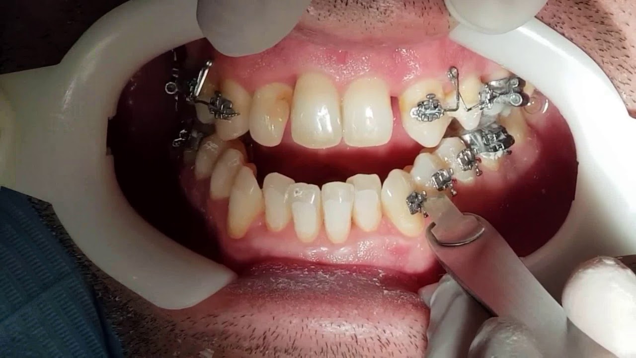 ADHESION BRACKETS DR GALLARDO CLINICAORTODONCIAJAEN