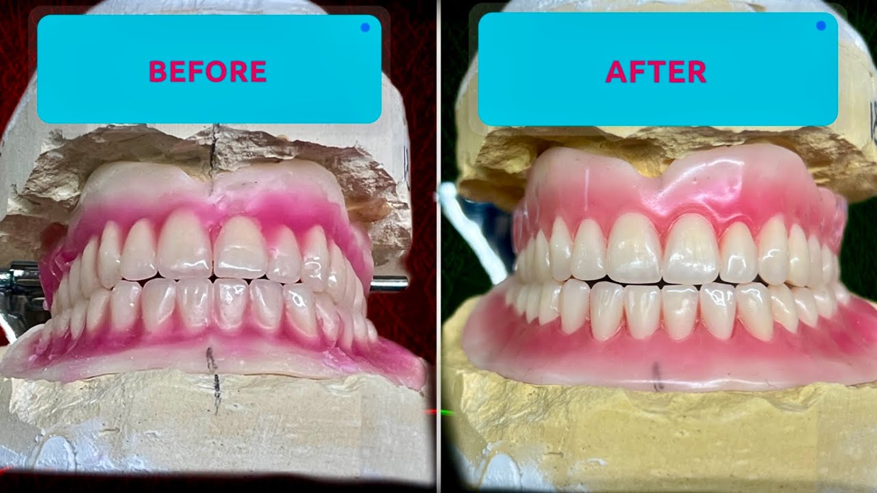 Learn Full Denture Wax-Up Step by Step 