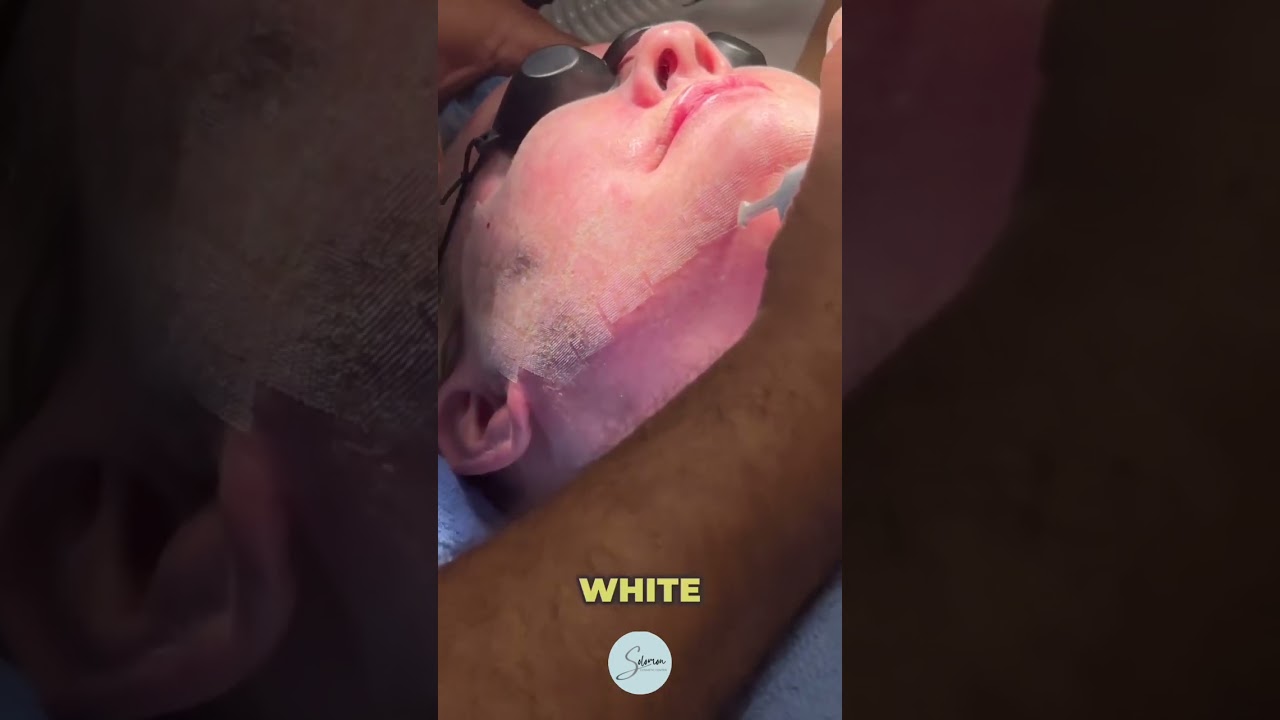 Inside the Procedure: Dr. Solomon Explains CO2 Laser Skin Tightening #CO2Laser