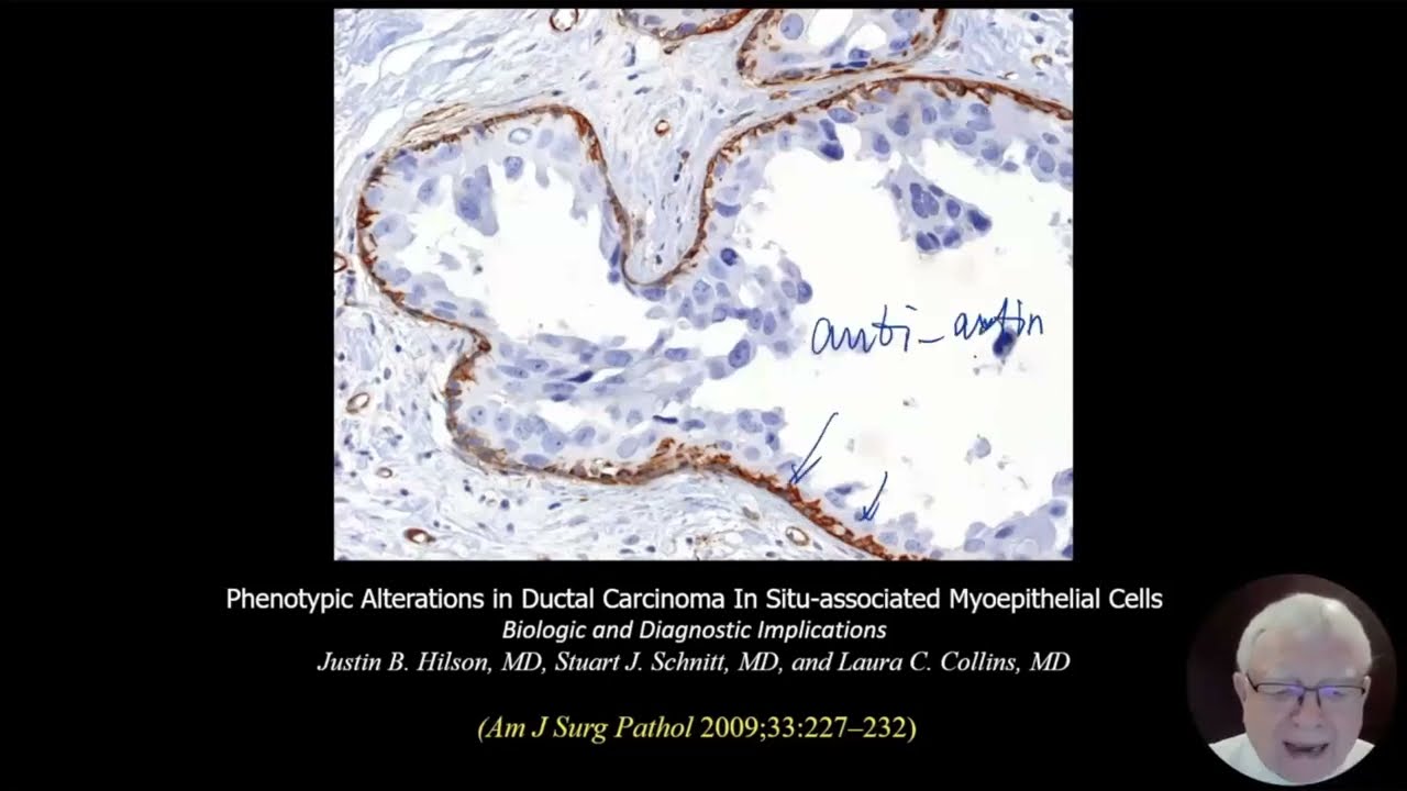 DAB (Ductal Аdenocarcinoma of the Breast) &ndash; Протоковая аденокарцинома молочной железы (часть 2)