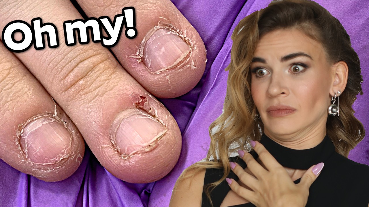 Bitten Nails Transformation to Natural Looking Acrylic Extensions