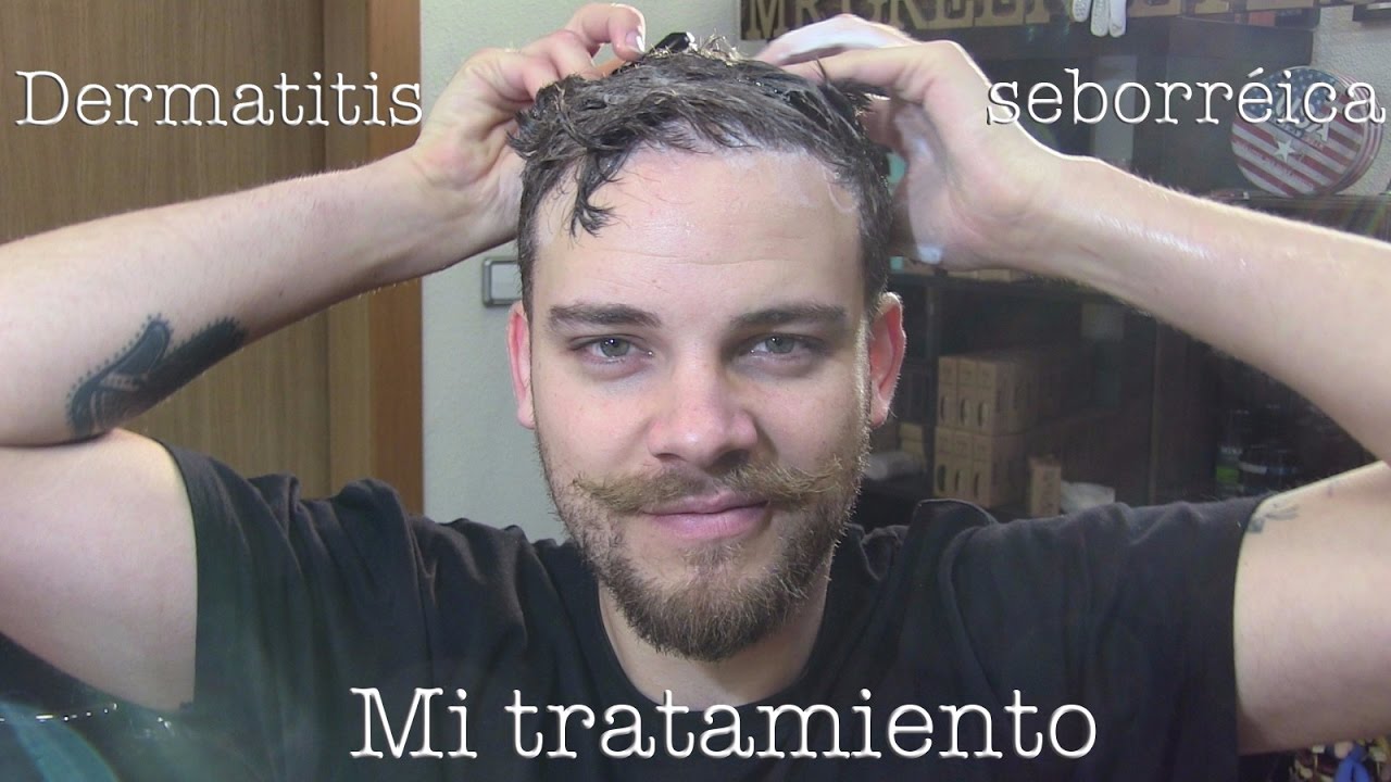 Tratamientos para la caspa seca y dermatitis seborreica. (CASO REAL)
