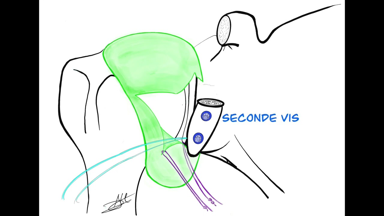 The Open Capsular Shift Latarjet Procedure Comics