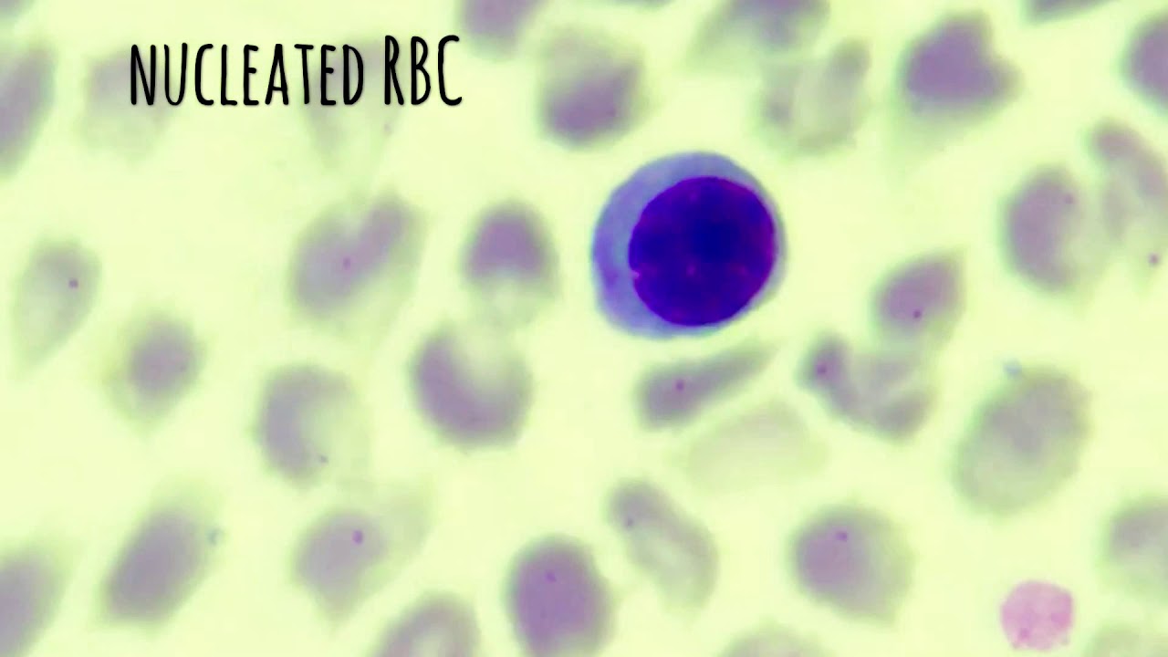 Nucleated RBC in blood smear