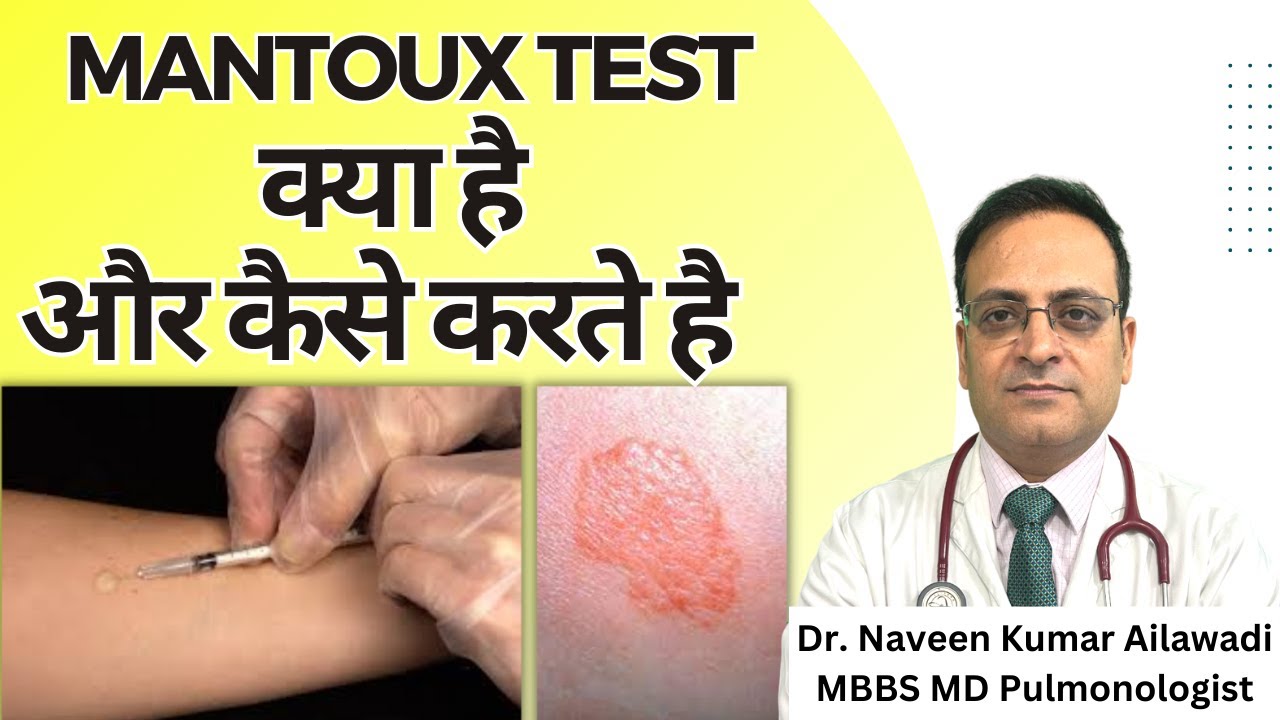 Mantoux Test क्या है और कैसे करते है | Mantoux tuberculin skin test (TST)| TB Test | Diagnosis of TB