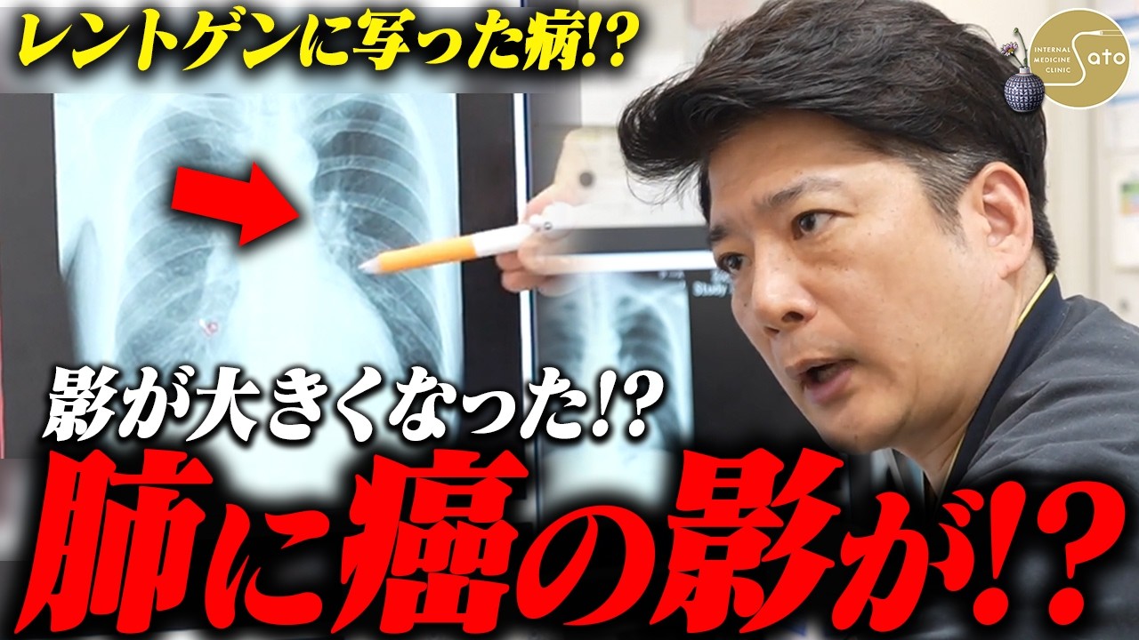 【恐怖】「CT検査で肺癌が判明！？」胃痛と肺の影を不安がる患者... 医師がレントゲン検査から導き出した症状の原因とは！？