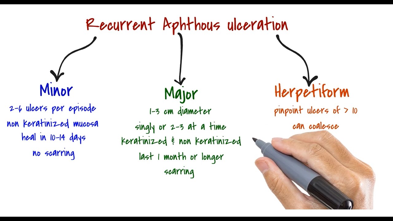 ORAL MEDICINE | Recurrent Aphthous Ulceration