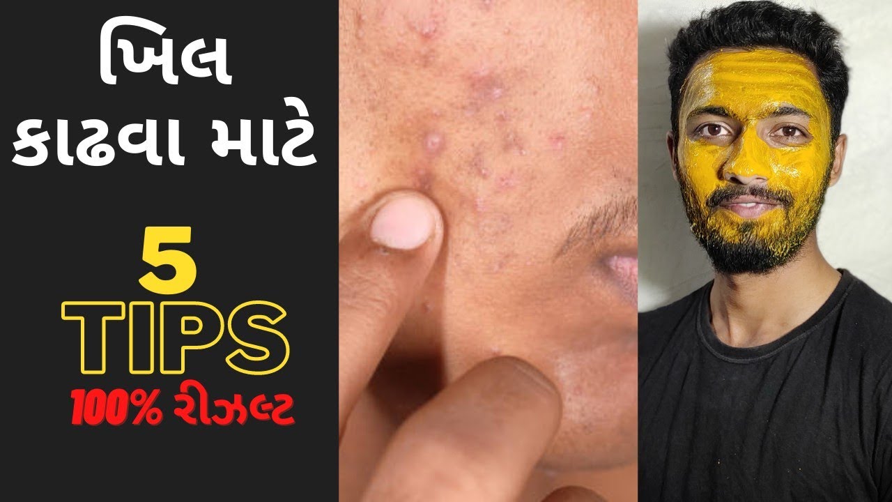 ખિલ કાઢવા માટે 5 ટીપ્સ ✔️ 100% Results 🔥 | ખીલની દવા | ખીલ મટાડવાના ઉપાયો