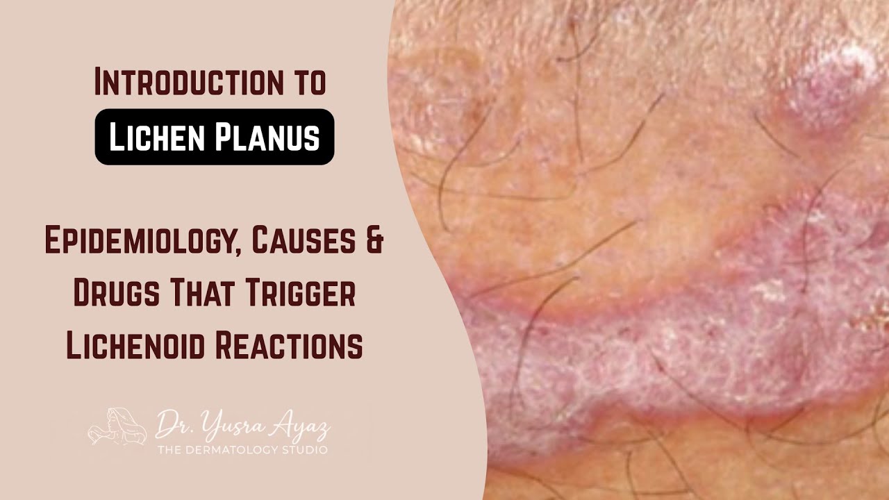 Lecture 1: Lichen Planus: Definition, Causes, Pathophysiology, Koebner Phenomenon & Wickham Striae