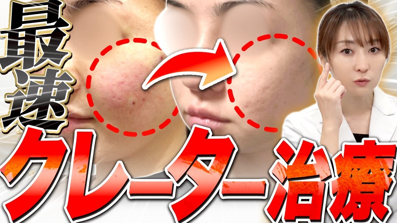 【30・40代 肌治療】ニキビ跡 クレーター治すにはどうしたらいい？保険治療？自費治療？