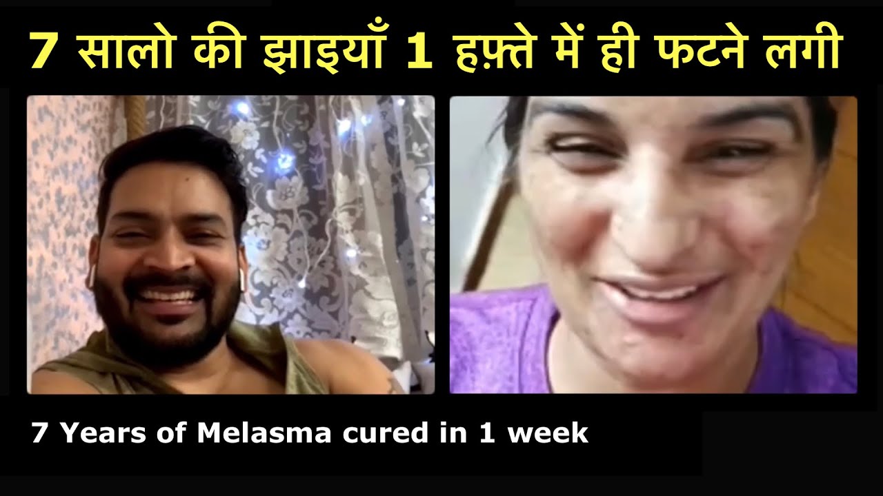 7 years of Melasma cured in 1 week. मेरी झाइयाँ 1 हफ़्ते में ही फटना शुरू हो गई।