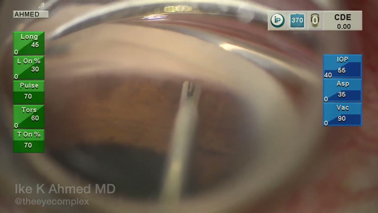 Dr. Ike Ahmed - iStent inject W Surgical Footage