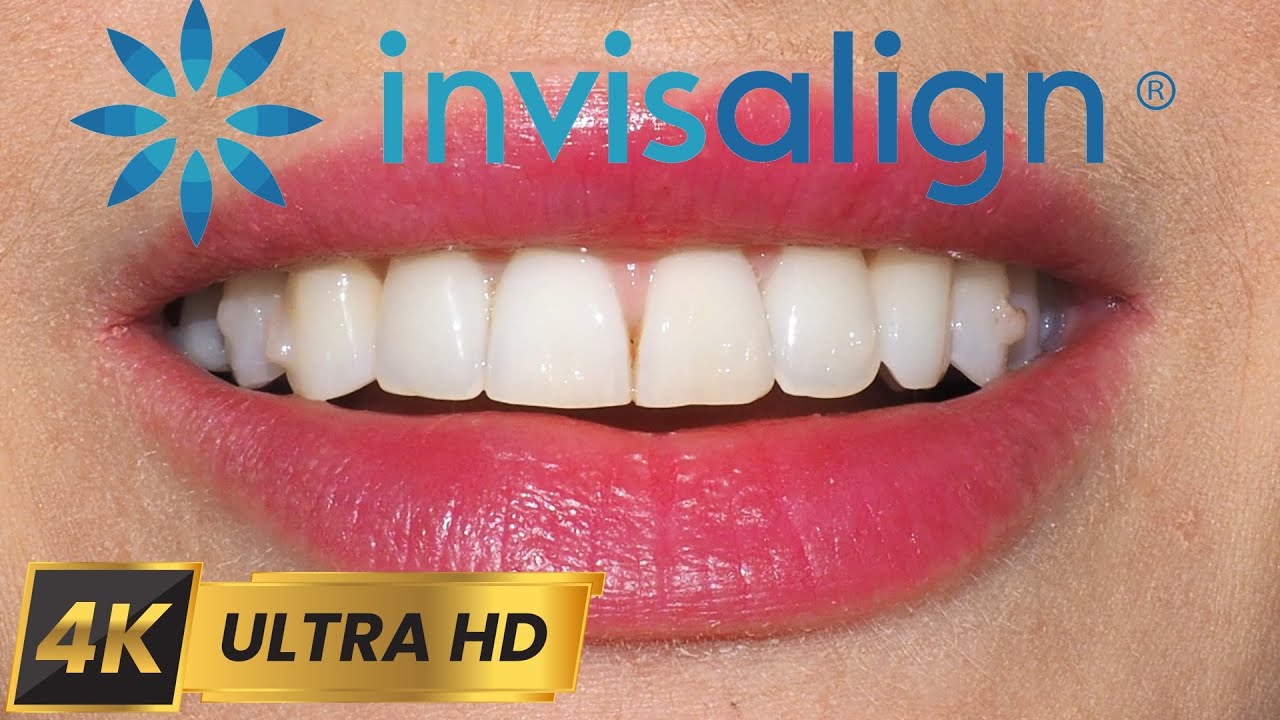 INVISALIGN timelapse — путешествие: от глубокого прикуса до уверенной улыбки в 4K 💚