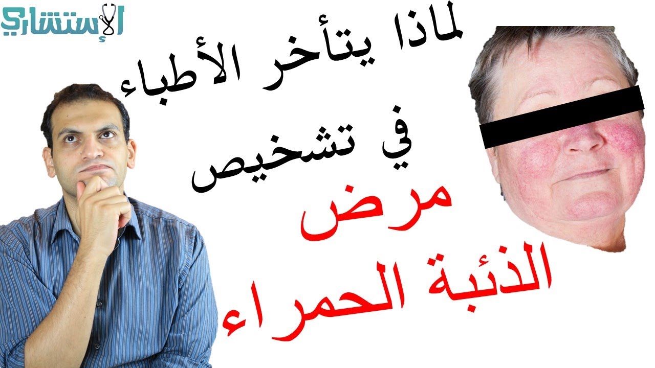 تشخيص الذئبة الحمراء الأعراض والتحاليل ودور الطبيب في التشخيص | الاستشاري