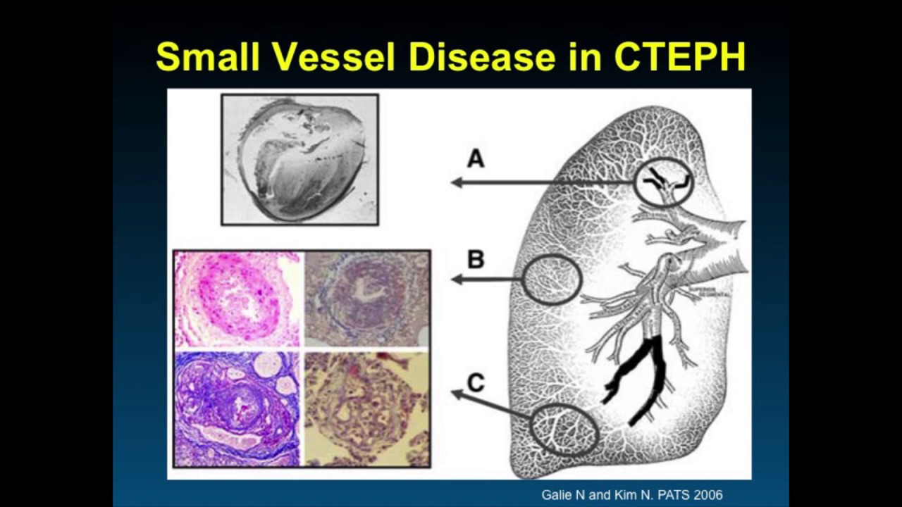 CTEPH- Pulmonary Hypertension and Balloon Pulmonary Angioplasty