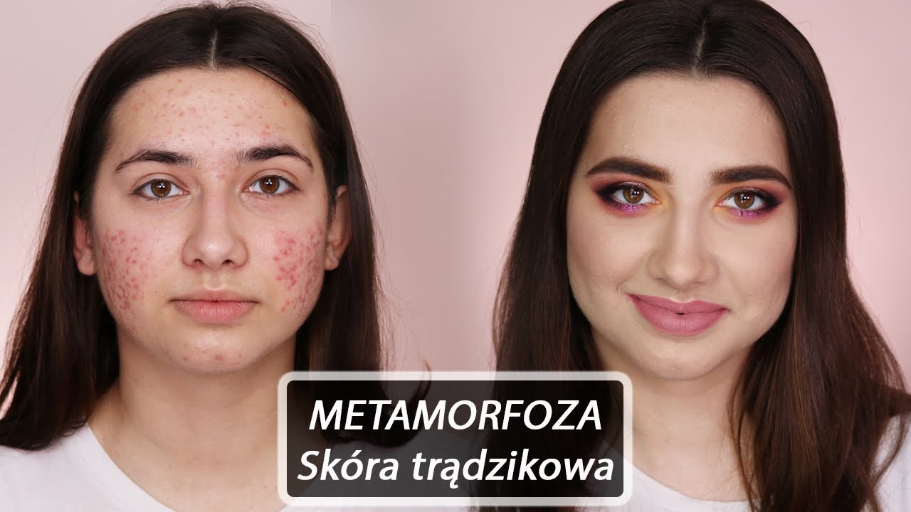 Metamorfoza 🔥 Kamuflaż dla skóry trądzikowej