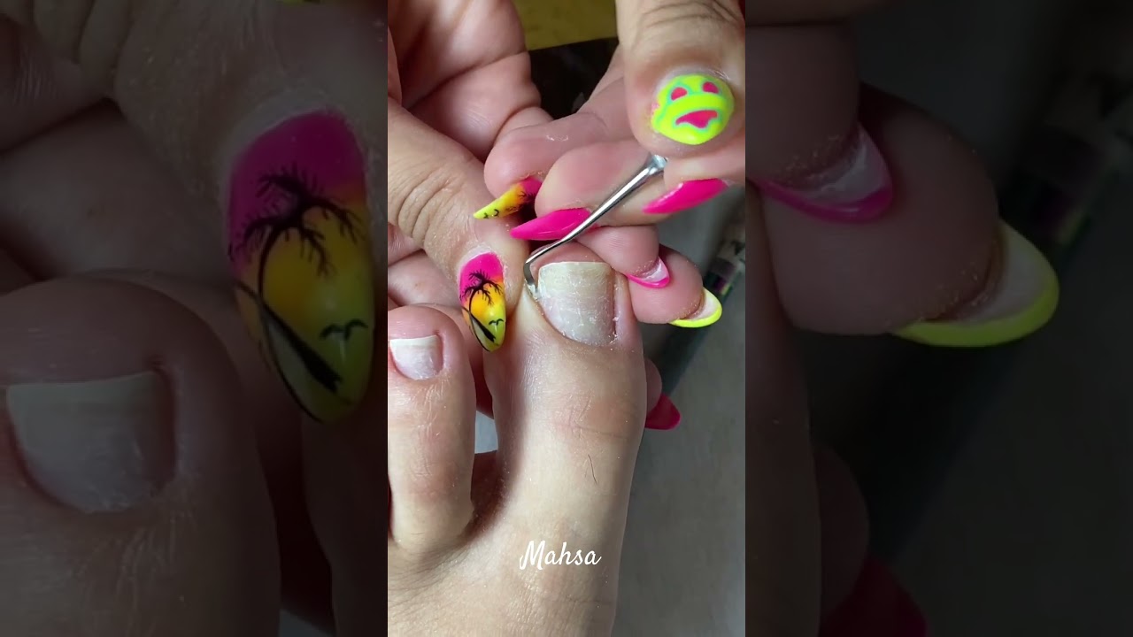 Batık tedavisi ‼️ #keşfet #youtubeshorts #keşfetteyiz #fypシ #izmir #nailart #mahsanailstudio
