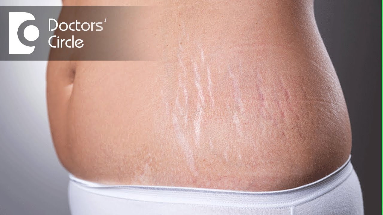 Laser treatments for stretch marks after delivery - Dr. K Prem Anand