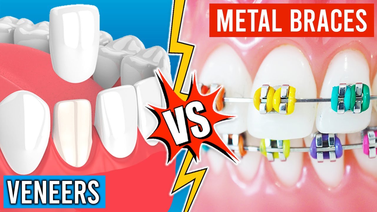 Veneers vs. Braces! | What is the Best Option For You?