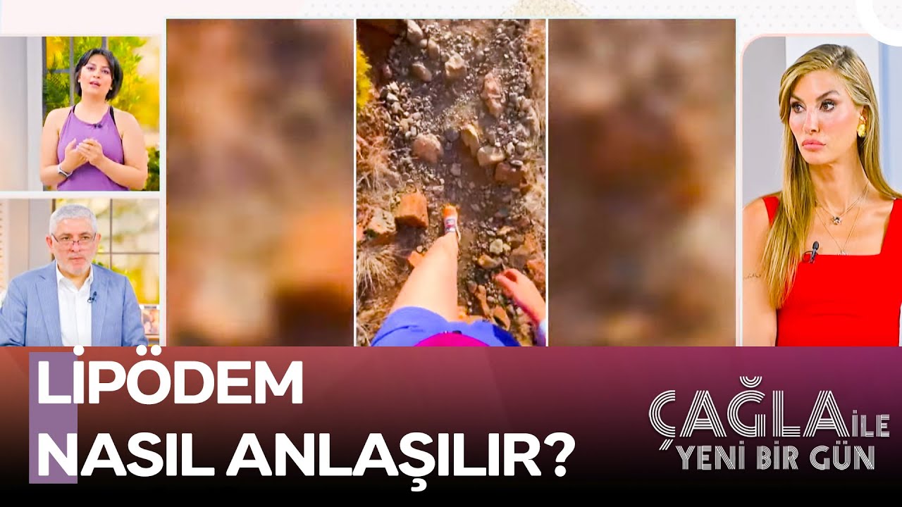 Lipödem Bir Damar Hastalığı Mı? - Çağla ile Yeni Bir Gün 1437. Bölüm