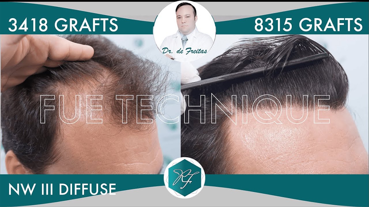 Hair Graft Technique FUE Grafts 3418 (8315 Hairs)