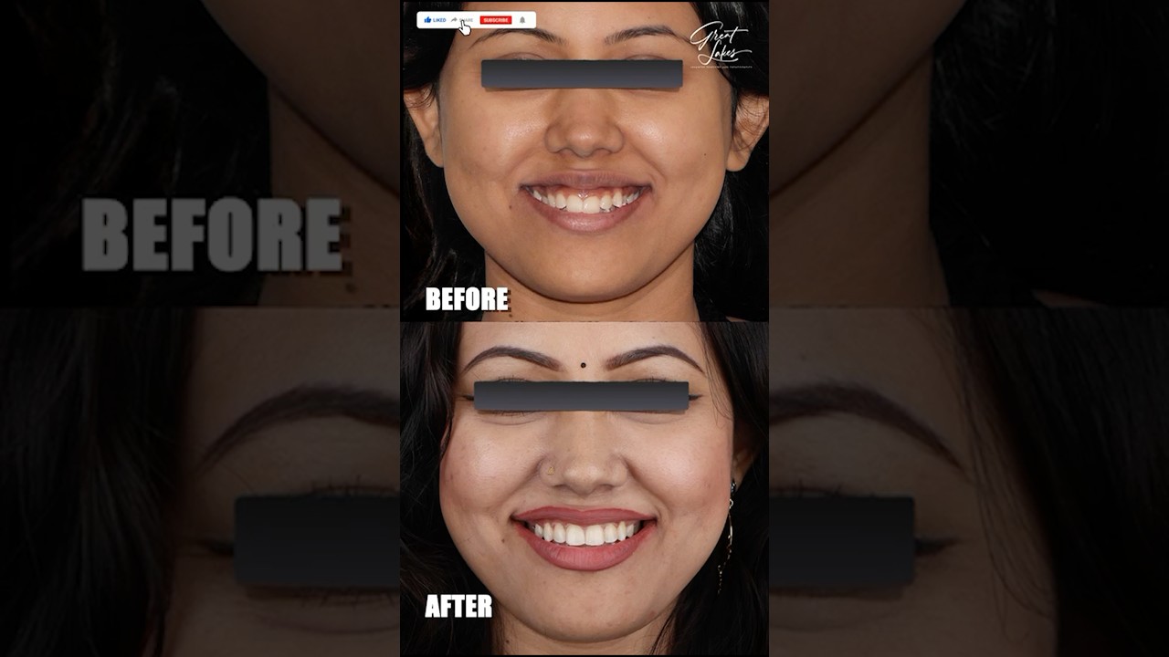 Before and After Orthodontic Treatment | Dental Braces | Clear Aligner- #dentist #braces #invisalign