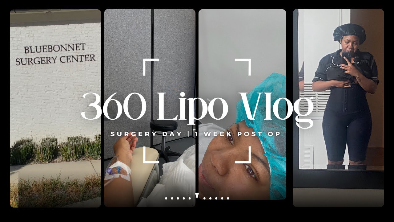 | 360 Lipo Vlog | Surgery Day ! | Prescription Fiasco | 1 Week Post Op | Lymphatic Massages & More!