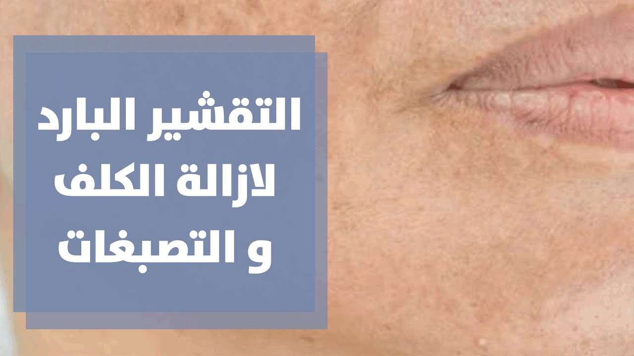 التقشير البارد لازالة الكلف و التصبغات