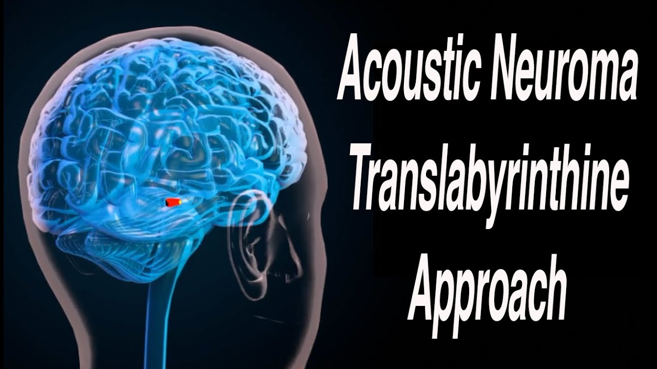 Translabyrinthine Approach to Acoustic Neuroma Surgical Removal
