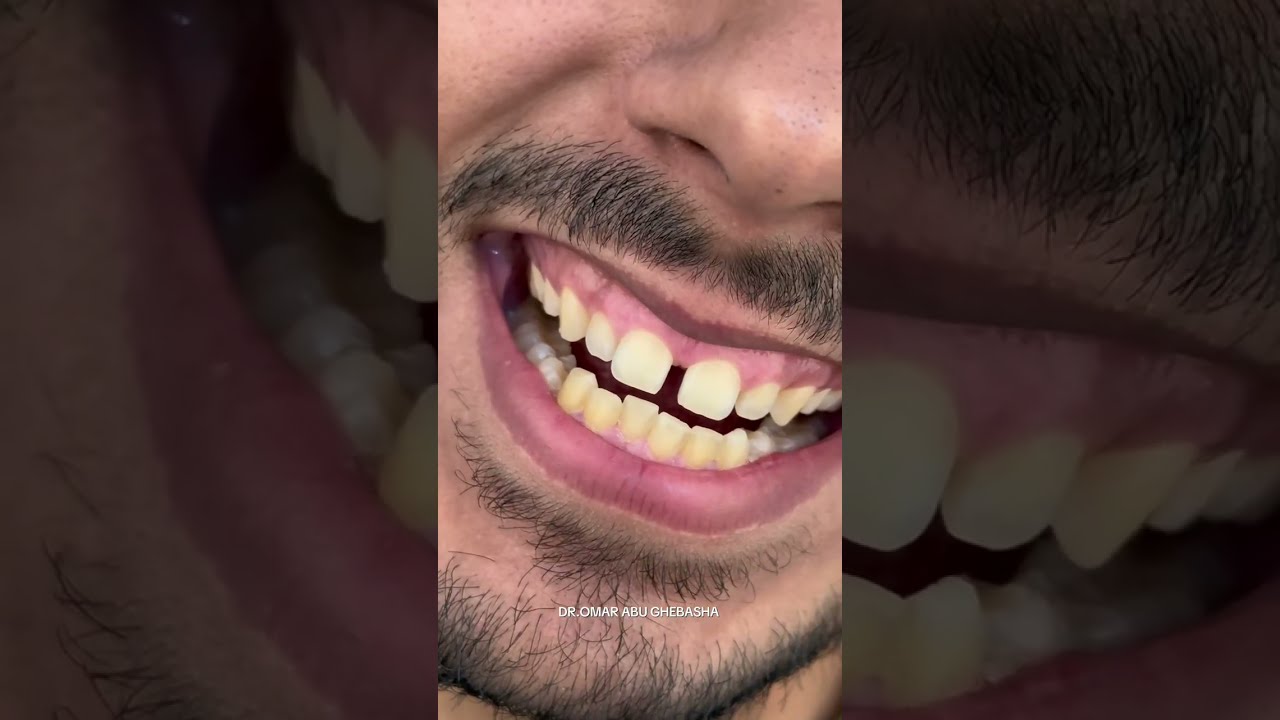 اصلاح الفلجة في الاسنان الامامية _ مسافة فاصلة بين الاسنان الأمامية 